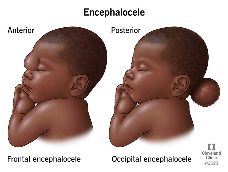 Two babies with encephalocele at the front and back of the skull.