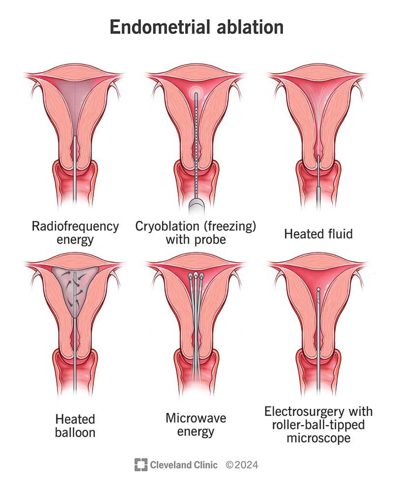 The six different methods for endometrial ablation, including heated balloon, microwave energy and cryoblation