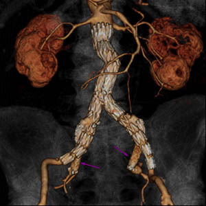 Digitální CT ukazující endovaskulární stentování aneuryzmatu břišní aorty s bilaterálními aneuryzmaty kyčelního kloubu