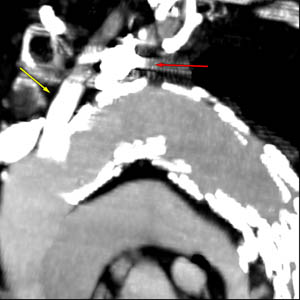 Hrudní aorta stentovaná červená šipka: stent v proximální podklíčkové tepně žlutá: stent v levé společné krční tepně
