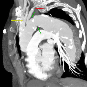 CT, jossa näkyy rintakehän aortan aneurysma ennen leikkausta