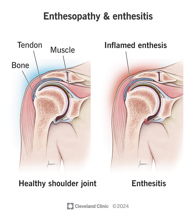 Enthesopathy is a broad term for any condition or injury that affects the places tendons and ligaments connect to bones.