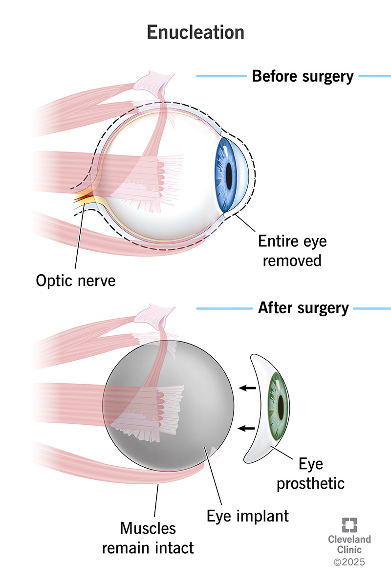 Enucleation is surgery to remove your eye, its contents and part of your optic nerve