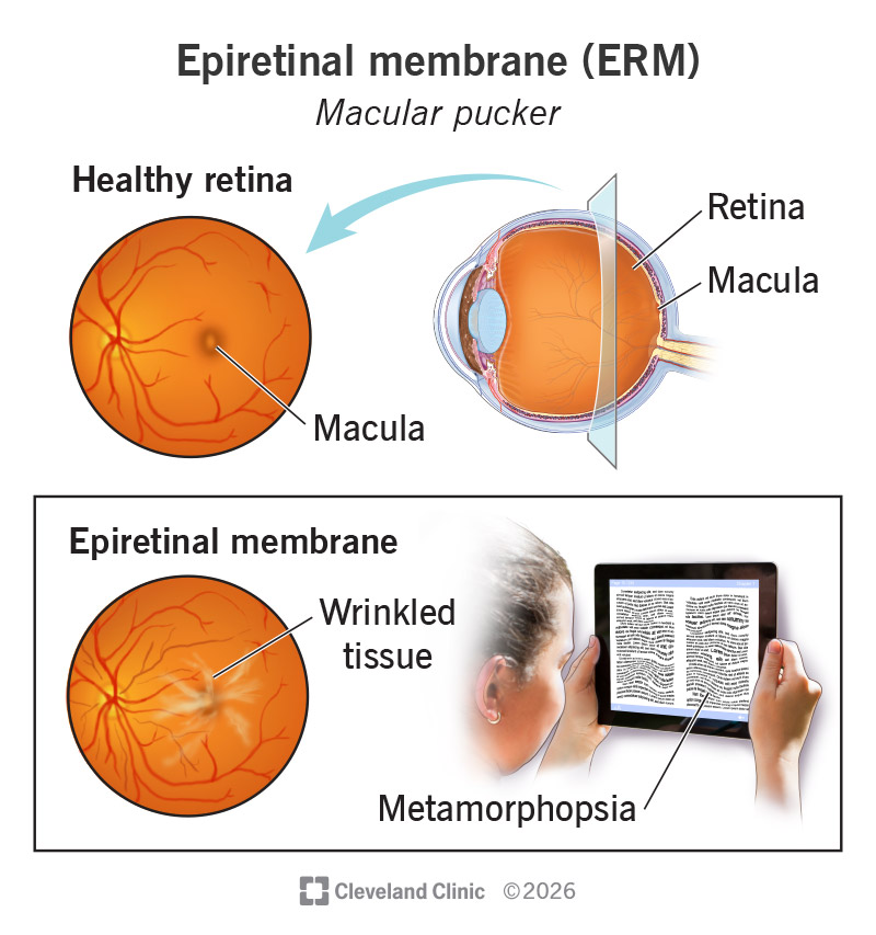 Epiretinal membrane causing wrinkled tissue and distorted vision