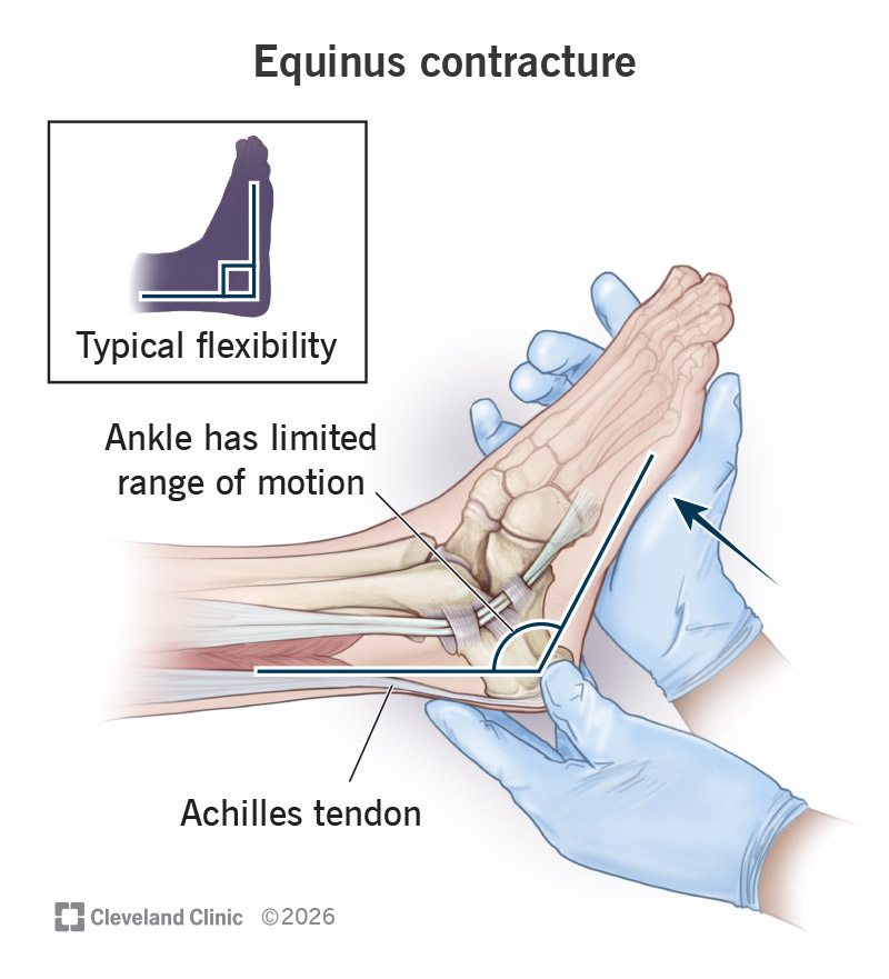 Equinus contracture in a right ankle compared to typical flexibility