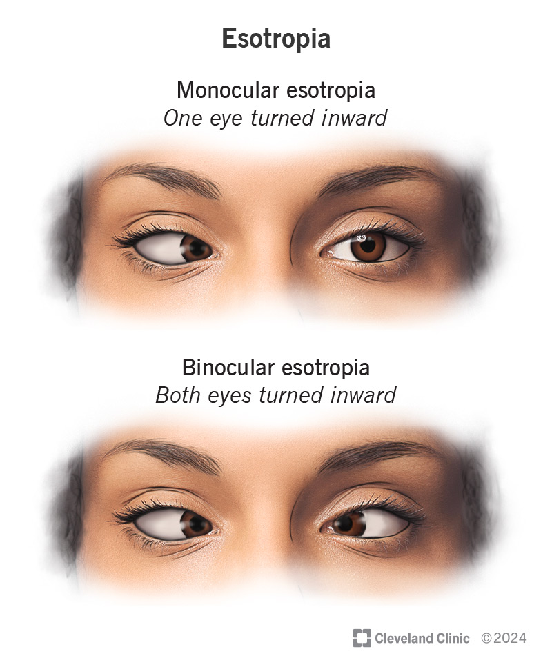 Example of monocular esotropia and binocular esotropia.