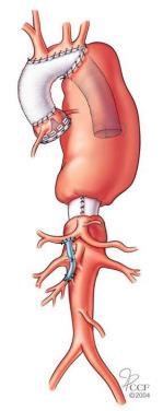 Fase 1 Olifantenstamprocedure