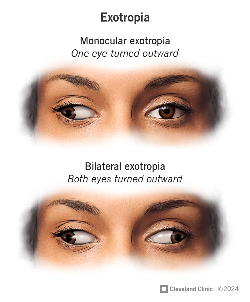 Example of monocular exotropia and bilateral exotropia