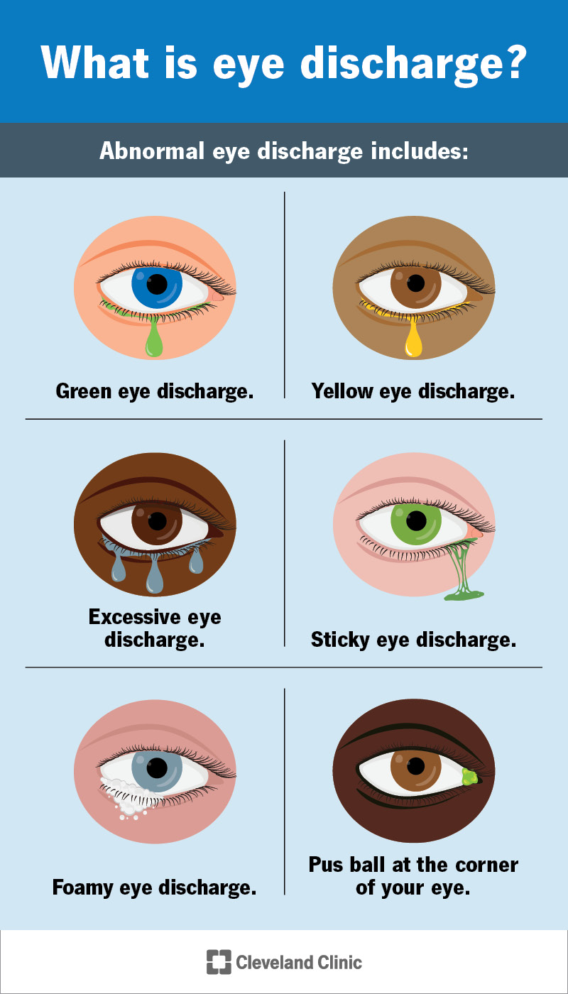 Abnormal eye discharge might be yellow, green, sticky or foamy.