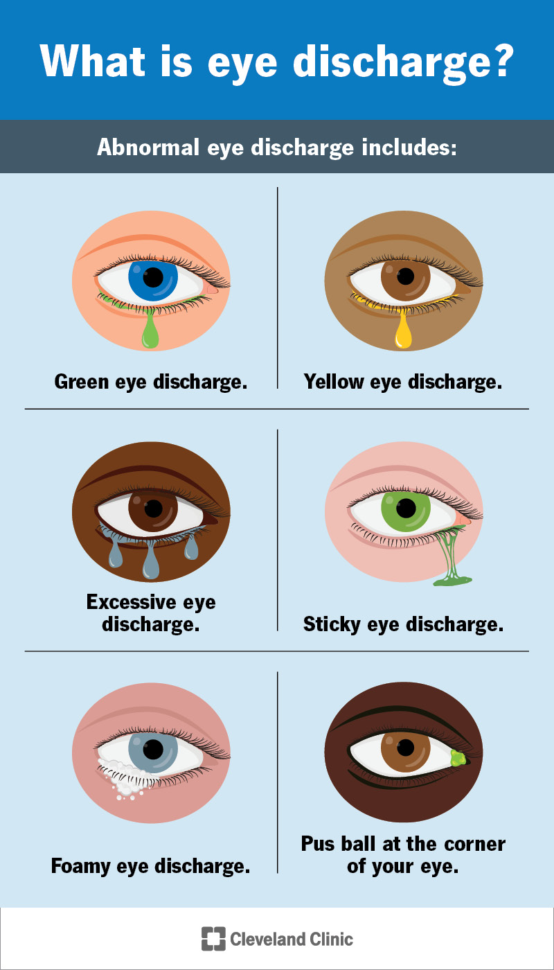 Eye Discharge (Eye Mucus): Causes, Types & Treatment