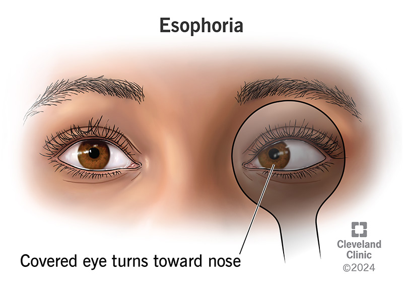 Esophoria means one of your eyes misaligns and turns toward your nose when covered.