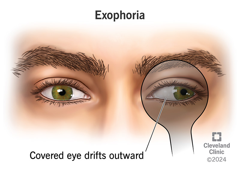 Exophoria means one of your eyes misaligns and turns away from your nose when covered.