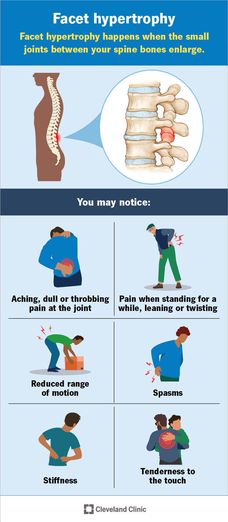 An enlarged view of the spine with swollen facet joints and facet hypertrophy symptoms