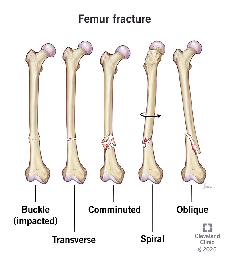 Comparison of different femur fracture patterns