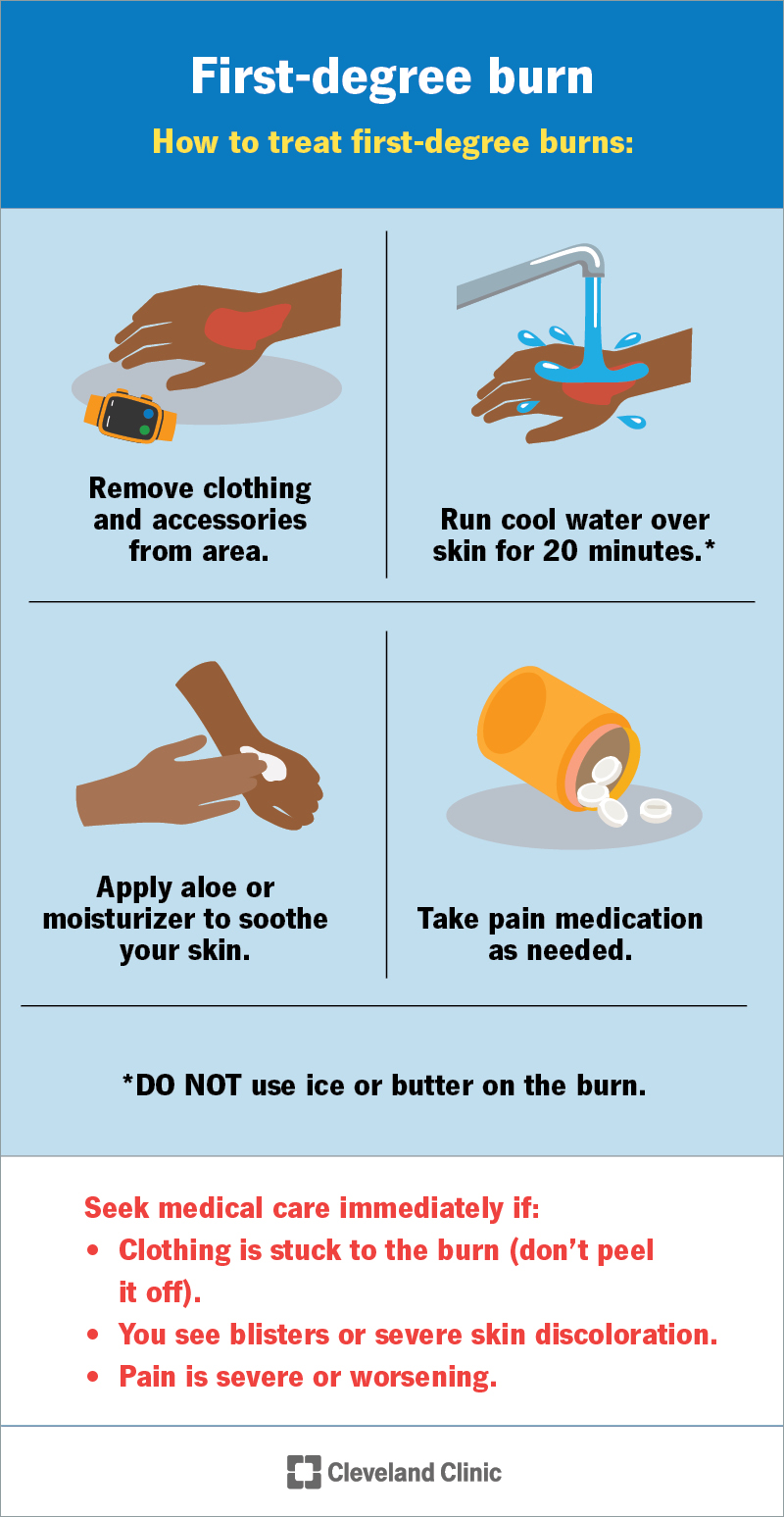How to assess and treat first-degree burns at home