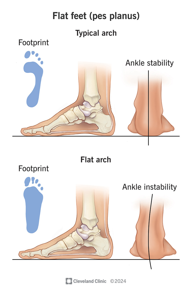 Illustration comparing a typical foot arch with a flat foot arch.