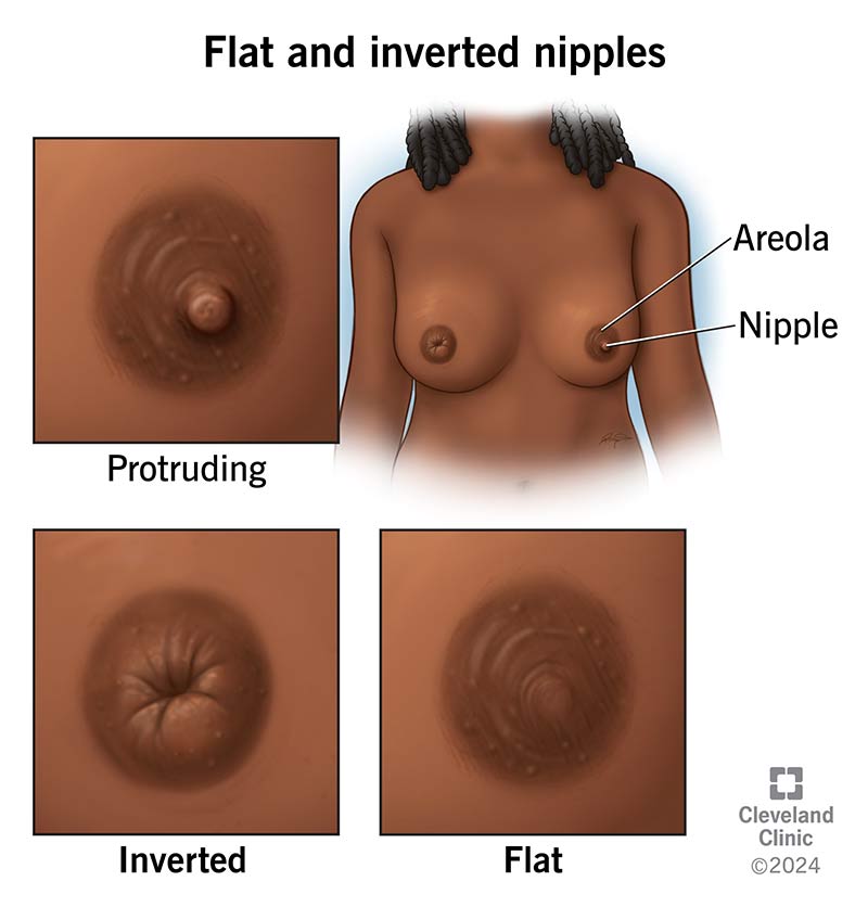 Normal variations of female breast anatomy include protruding, flat and inverted nipples.