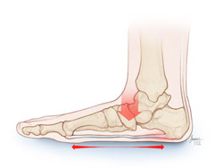 When Patients Cannot Tolerate Arch Supports