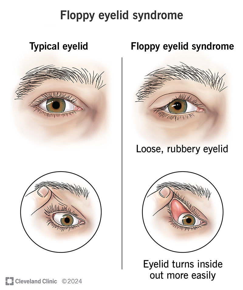 Floppy eyelid syndrome affects your eyelid skin’s stretchiness, making it looser and easier to turn the lid inside out.