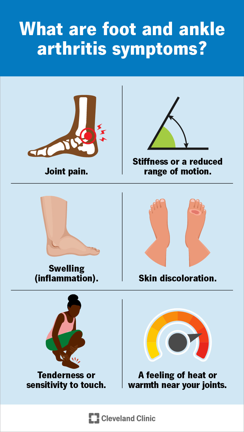 Arthritis in Foot & Ankle: Symptoms, Causes & Treatment