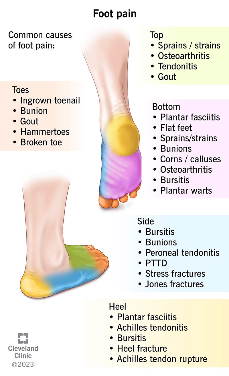 Causes of foot pain include sprains, strains, osteoarthritis, tendonitis, gout, plantar fasciitis, and more.