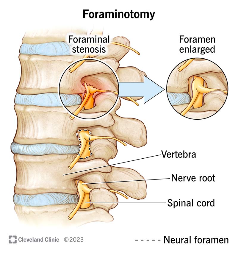 An illustration of the spine with foraminal stenosis and the outcome of a foraminotomy to open the foramen.