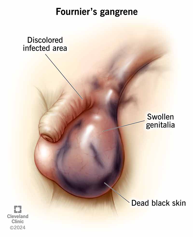 Discoloration and genital swelling associated with Fournier’s gangrene