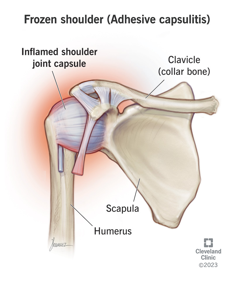 Frozen shoulder (adhesive capsulitis) is a painful condition in which your shoulder movement becomes limited