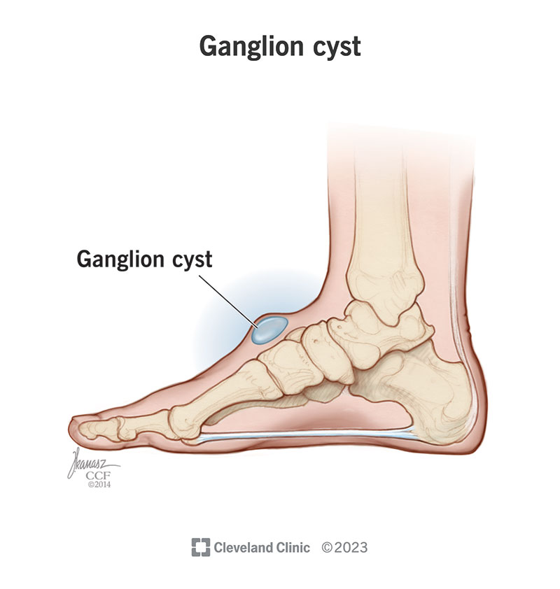 A ganglion cyst on a person’s foot.
