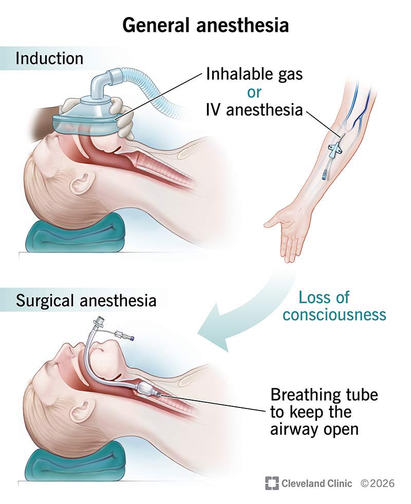 General anesthesia induction with inhalable gas or IV medication, and surgical anesthesia with breathing tube