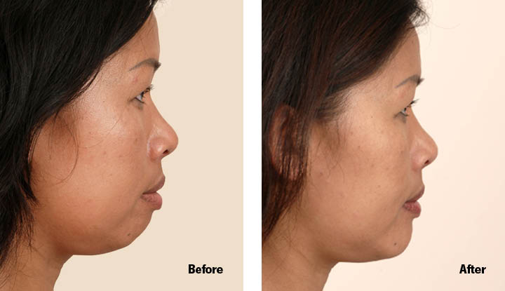 A person before and after genioplasty surgery on their chin.