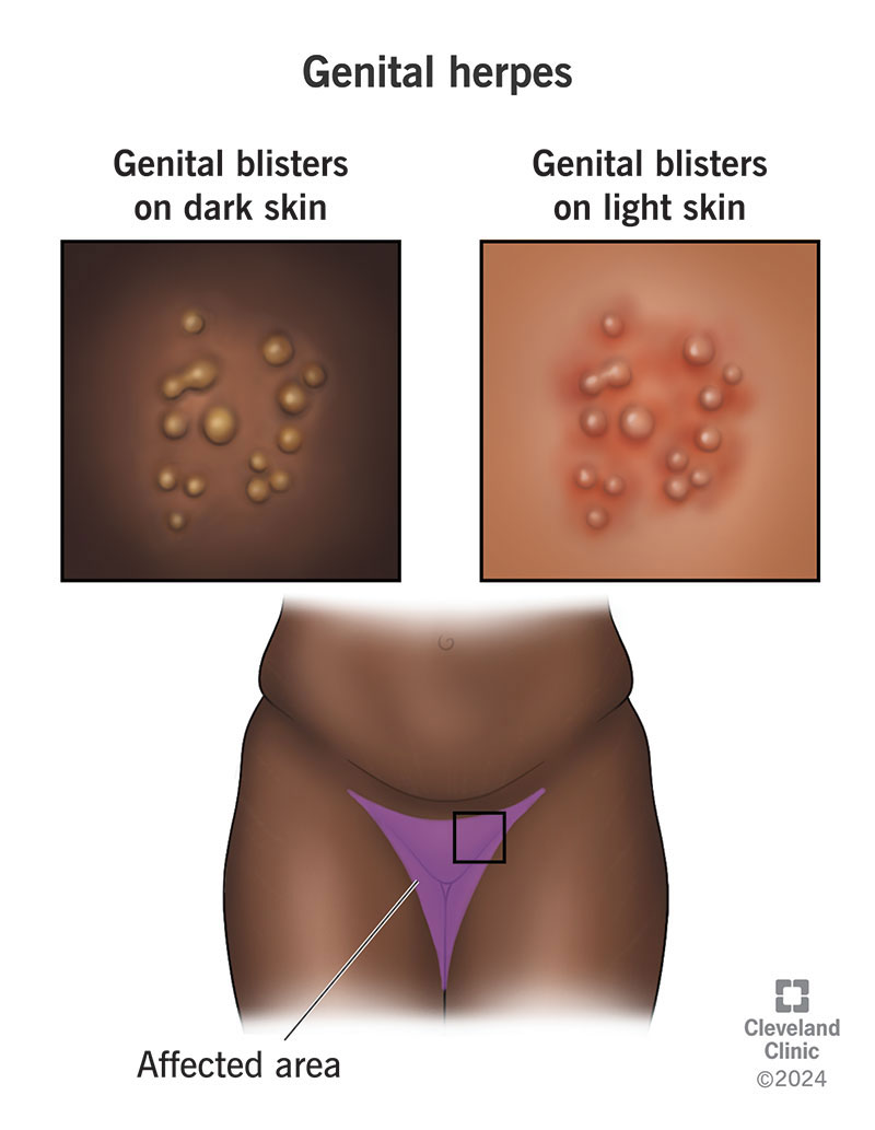Genital herpes on light skin and dark skin