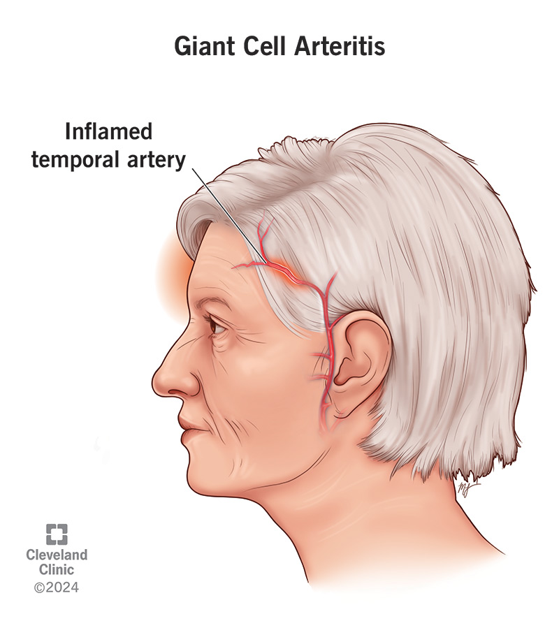 Inflamed temporal artery on left side of the head in a woman with giant cell arteritis (formerly temporal arteritis).