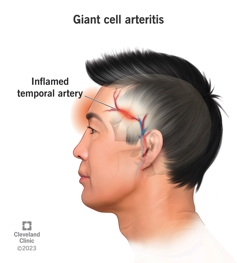 An inflamed temporal artery due to giant cell arteritis.