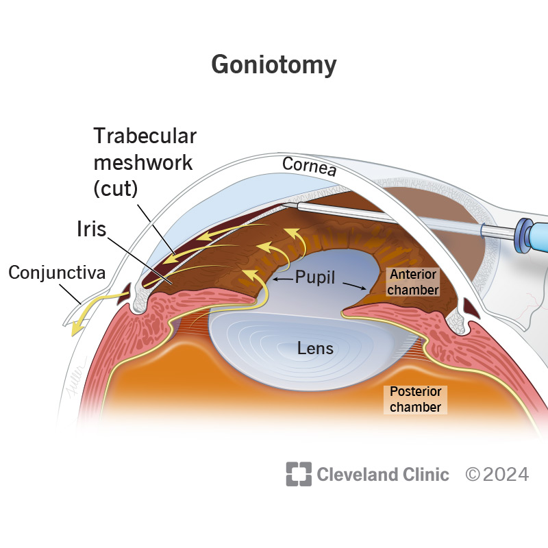 Goniotomy involves making small cuts inside your eye to increase aqueous humor fluid drainage out of your anterior chamber.