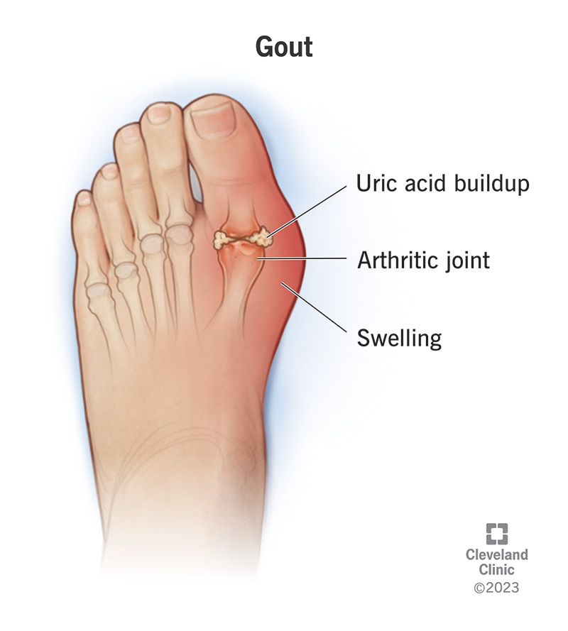 An illustration of gout in a big toe joint.