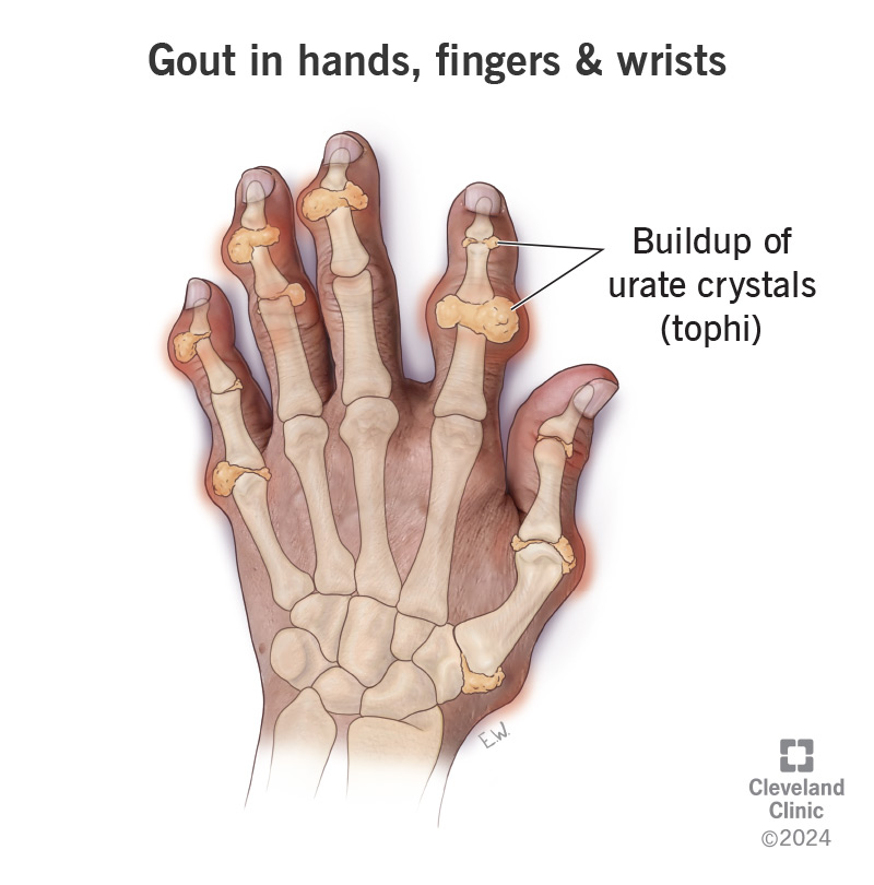 Urate crystals (tophi) built up in the finger joints