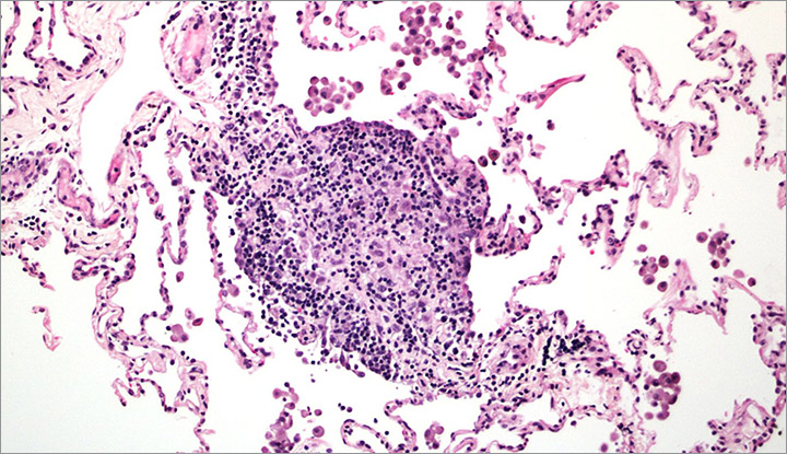 Microscopic ganulomas, with areas of light purple staining with darker purple dots
