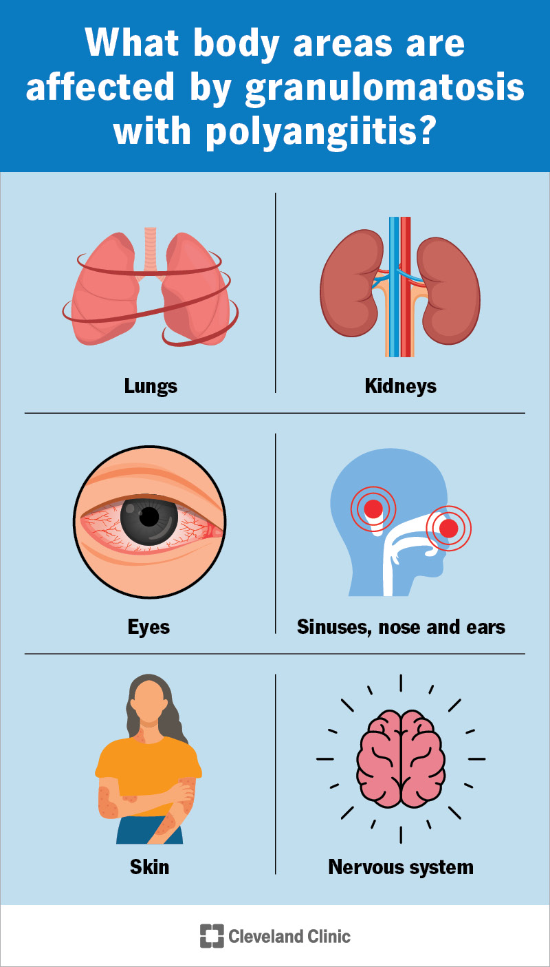 Granulomatosis with polyangiitis can affect many parts of your body.