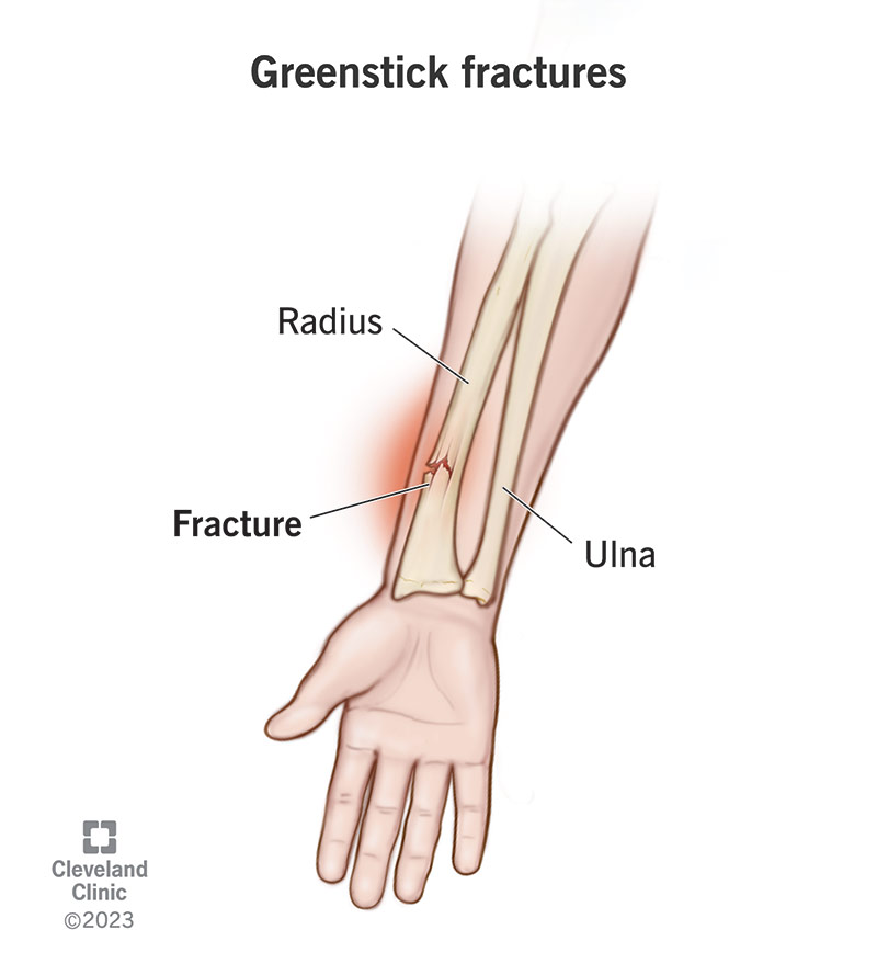 Greenstick fractures usually affect kids’ long bones.