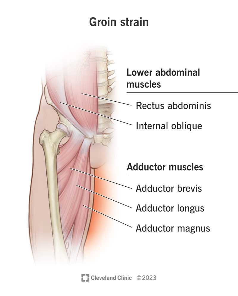 Groin Strain Causes Symptoms Tests Treatments