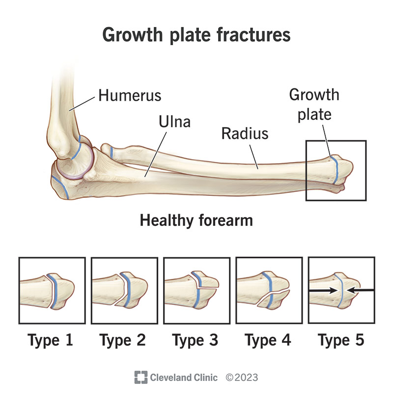 Healthcare providers classify growth plate fractures into five types.
