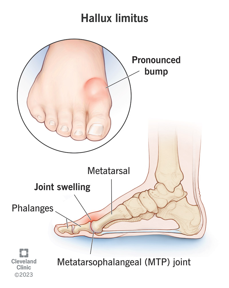 Bones and joints in foot, with big toe joint (MTP joint) inflamed as in hallux limitus.