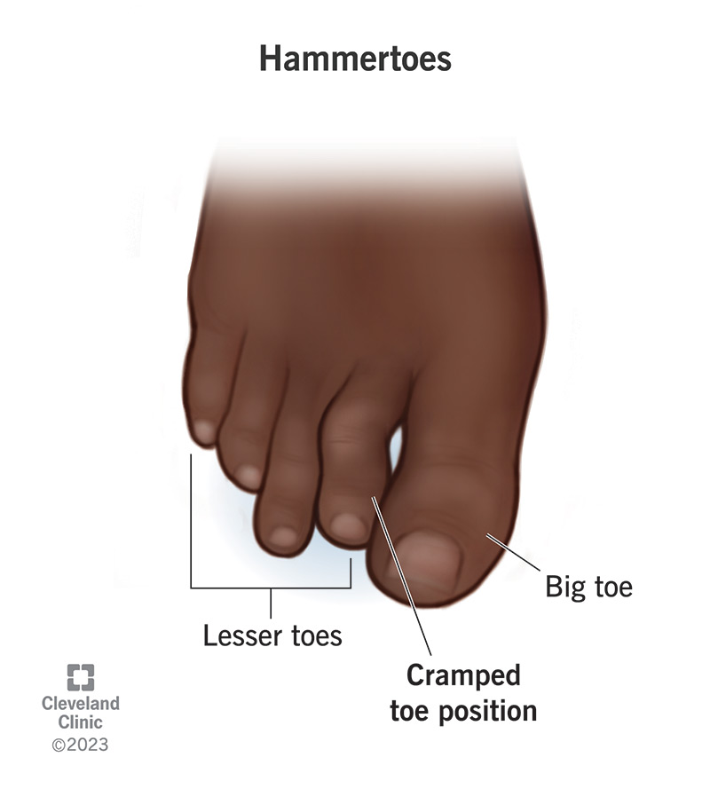 Hammertoes usually develop in the second joint of your lesser toes
