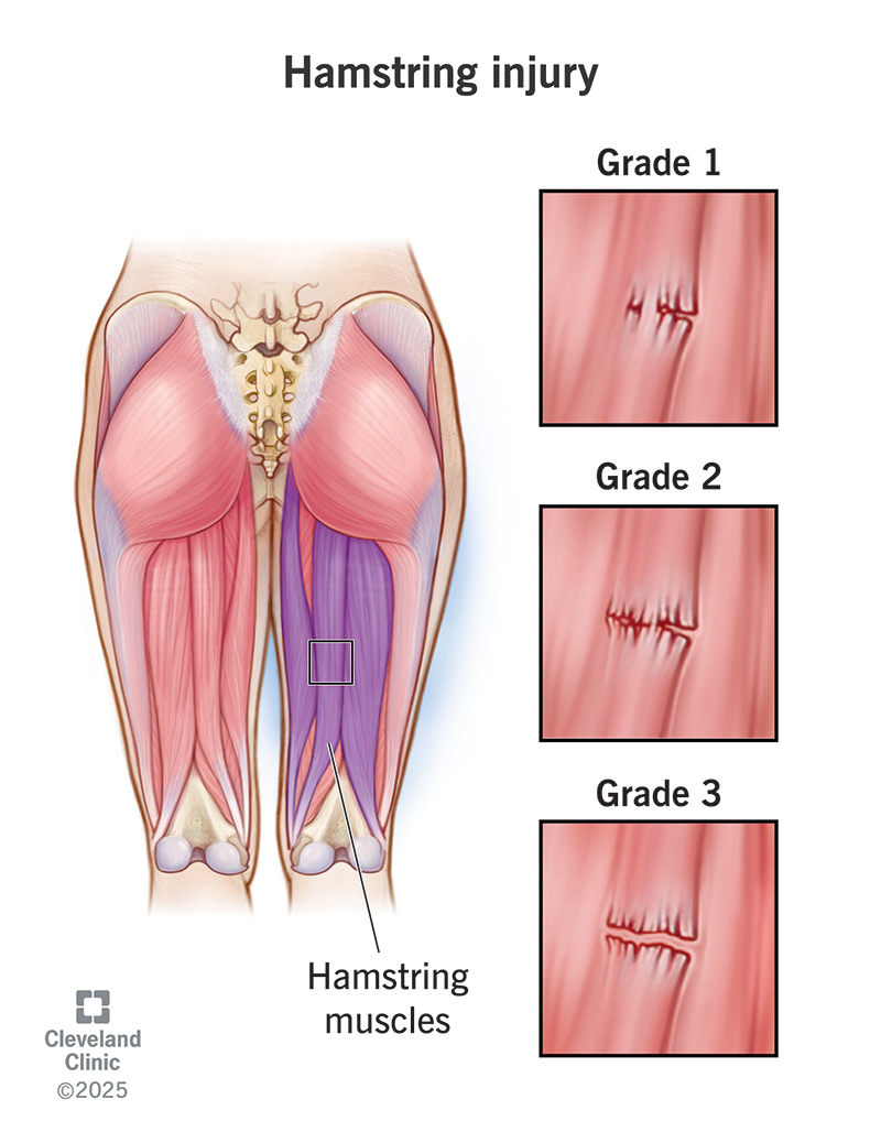 Pulled Hamstring Diagram 3 Types Of Pain In The Butt and What You Can