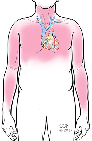 Heart Attack Myocardial Infarction