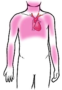 angina symptoms