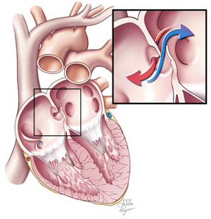 Patent Foramen Ovale (PFO)