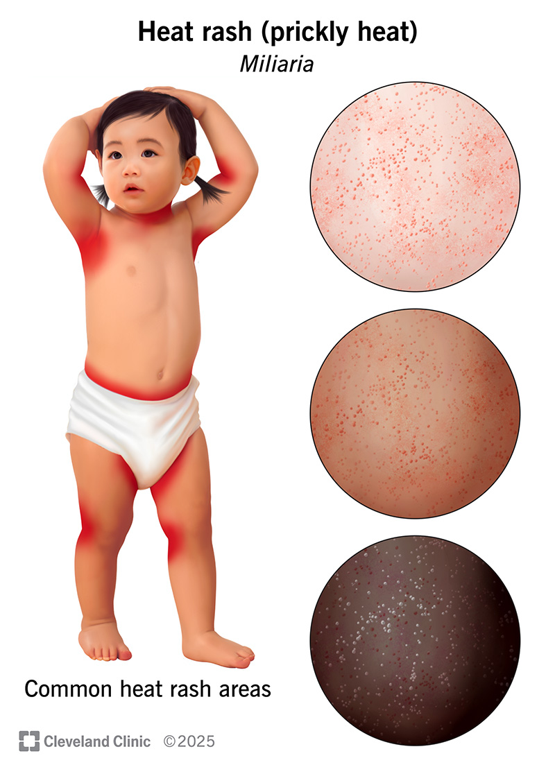 Best Treatment For Heat Rash Best Treatment For Heat Rash