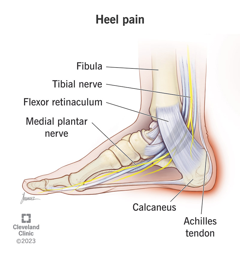 Heel pain can affect many different areas of your foot and ankle